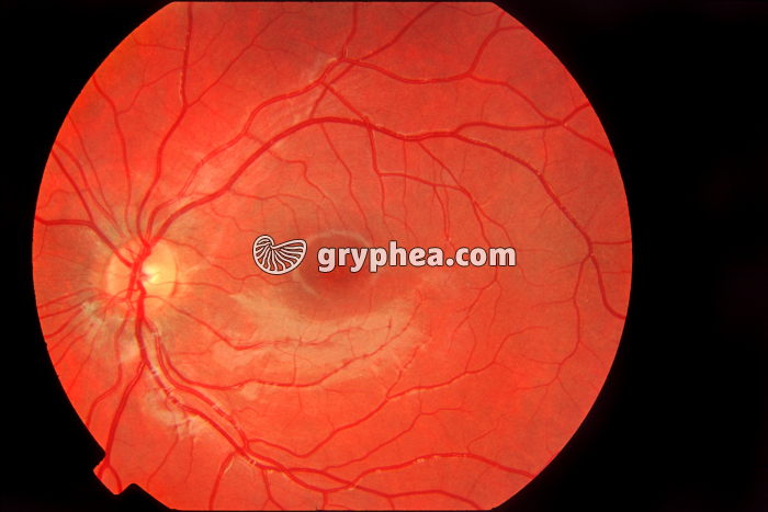 Fond de rétine - gryphea.org